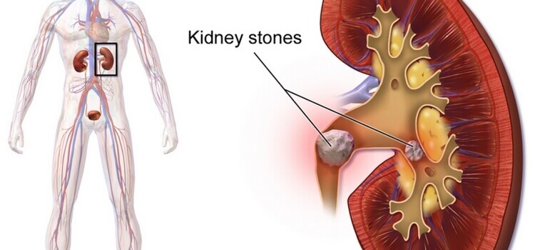 Kidney Stone Diagnosis & Treatment