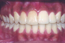 Post Orthodontic Treatment Photos