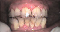 After Gum Disease Treatment