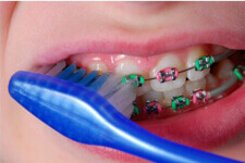 Metal Brackets for Orthodontic Treatment