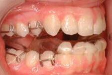 Functional Appliance Dental Treatment