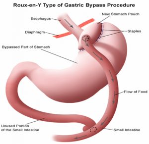 Obesity Surgery - Type of Gastric Bypass Procedure