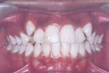 Pre Orthodontic Treatment Photos