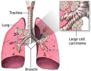 Lung Cancer Diagnosis & Treatment