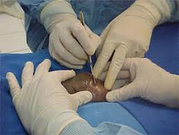 Surgical Extraction of Sperms