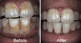 Before & After Gum Treatment Photos