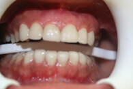 After Dental Veneers Treatment