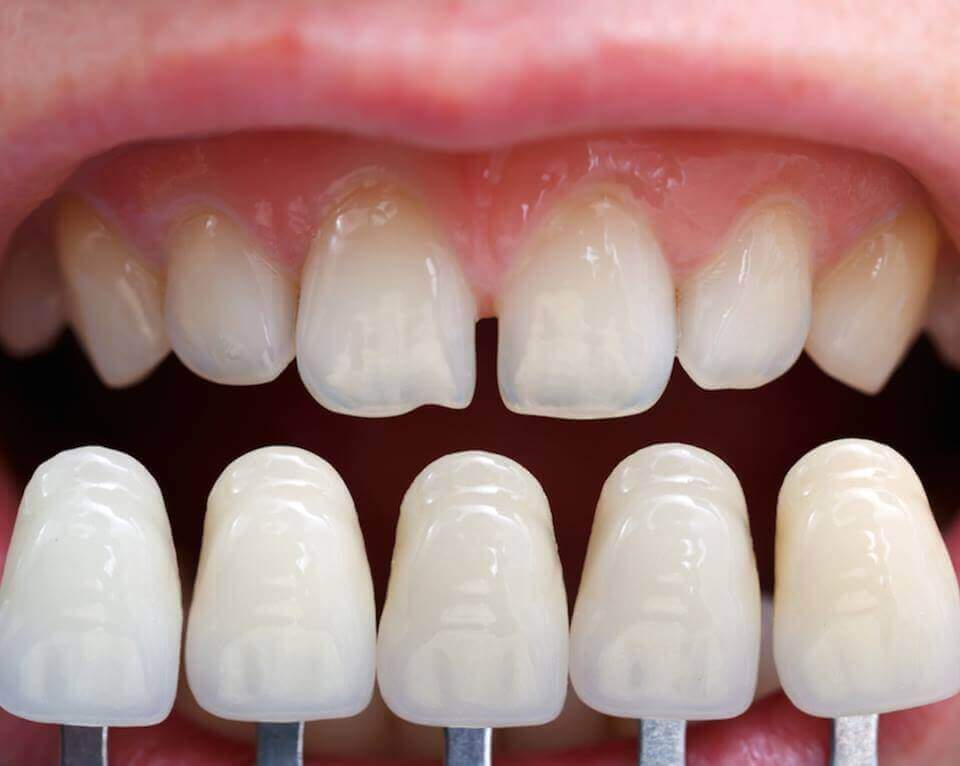Dental Cosmetic, Dental Implants