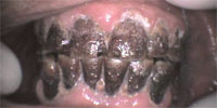 Before Gum Disease Treatment