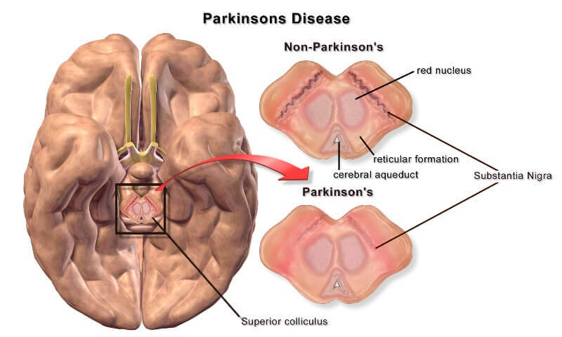 Parkinsons Disease, Symptoms, Causes, Treatment, Neurology