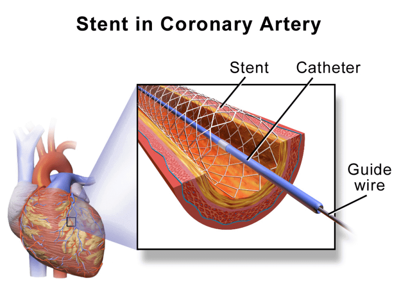Stent in Coronary Artery