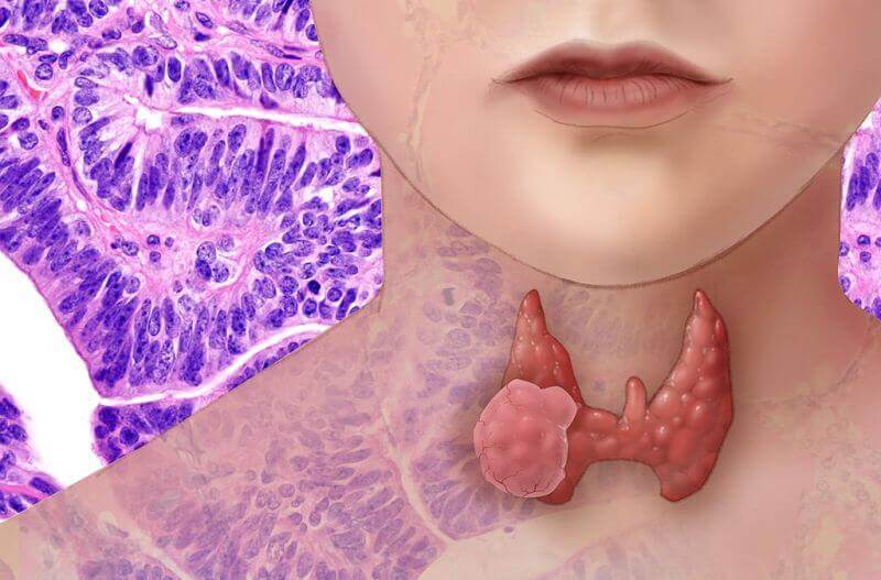 Thyroid Cancer, Thyroid Disorders