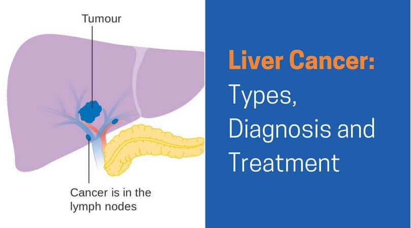 Liver Cancer, Liver Cancer Types, Liver Cancer Diagnosis, Treatment