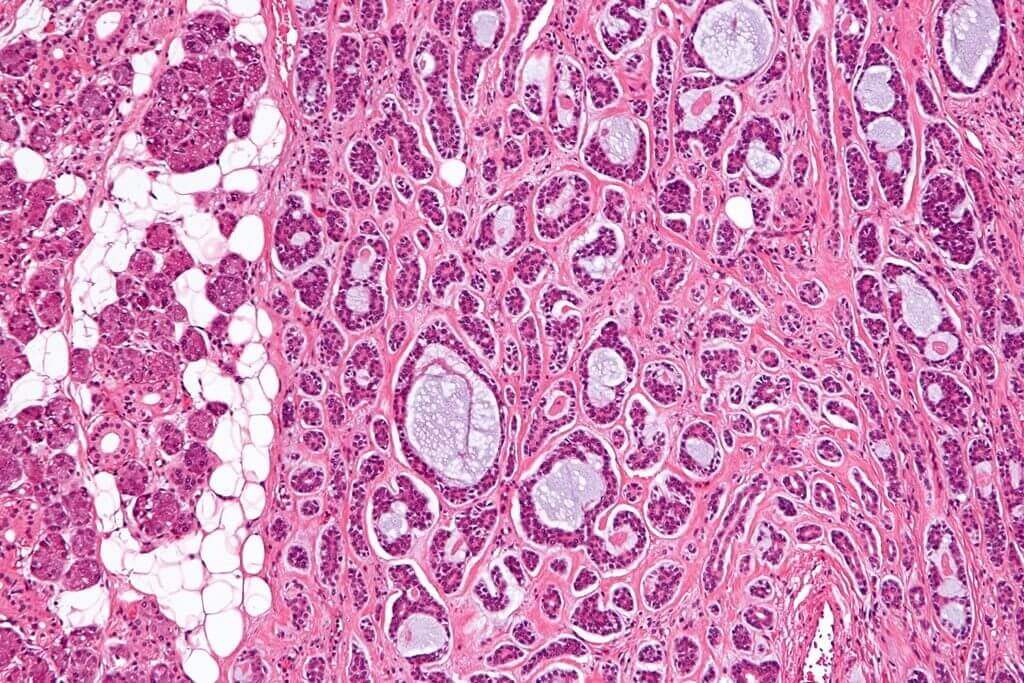 Adenoid Cystic Carcinoma, Salivary Glands tumors