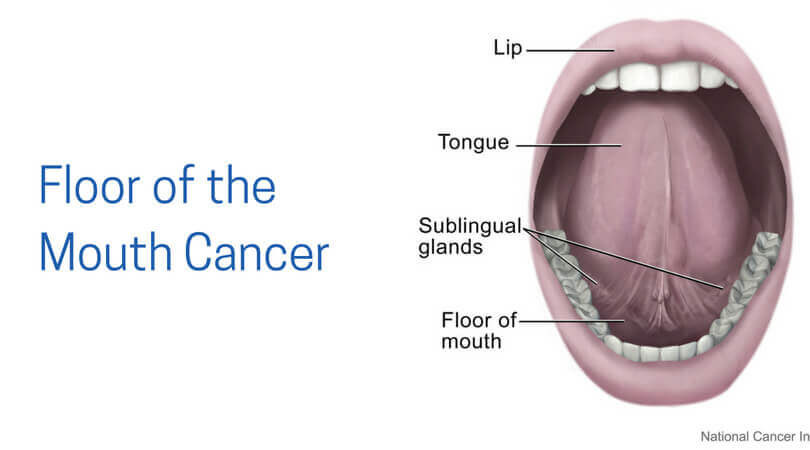 Floor of the mouth cancer