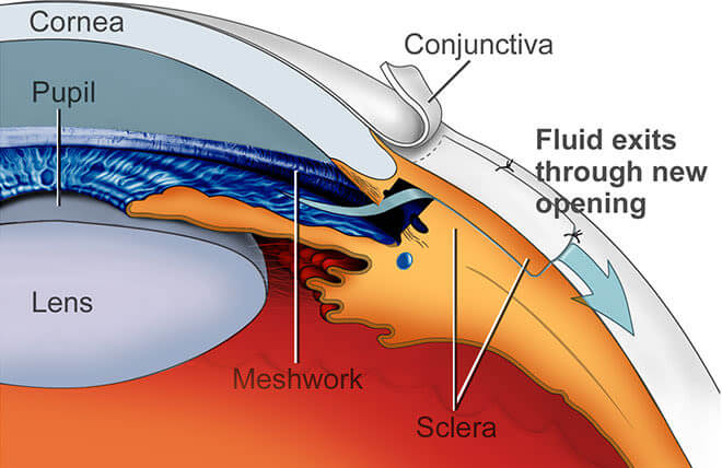 glaucoma surgery diagram