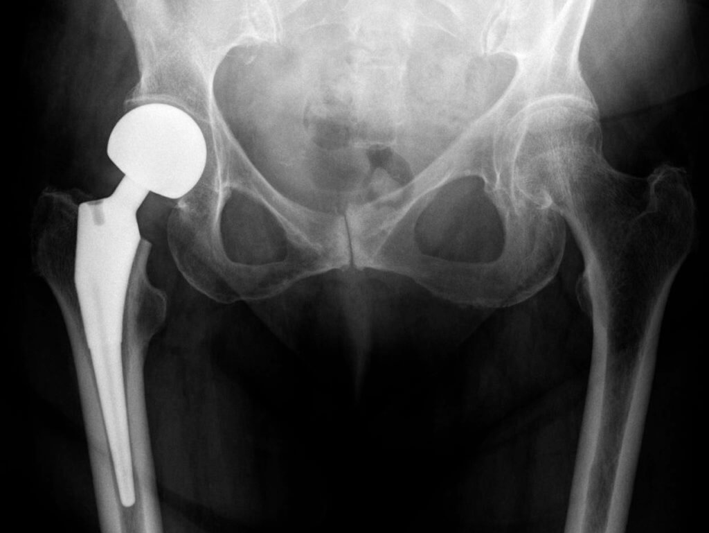 X-ray of hips with a hemiarthroplasty