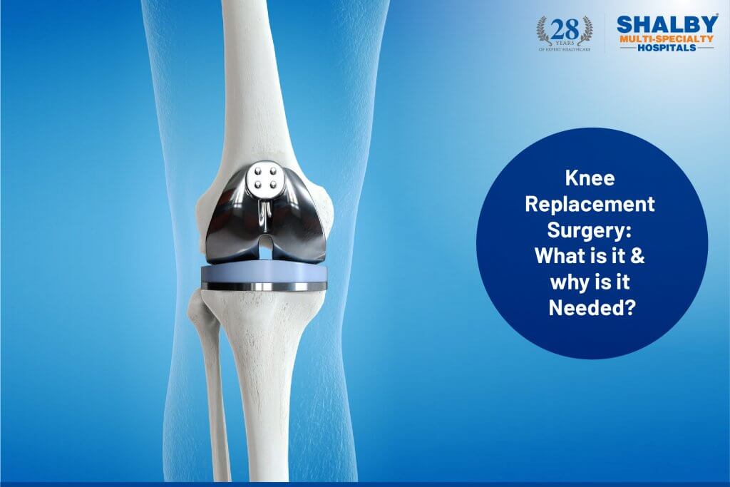 Total knee replacement - Shalby Hospitals