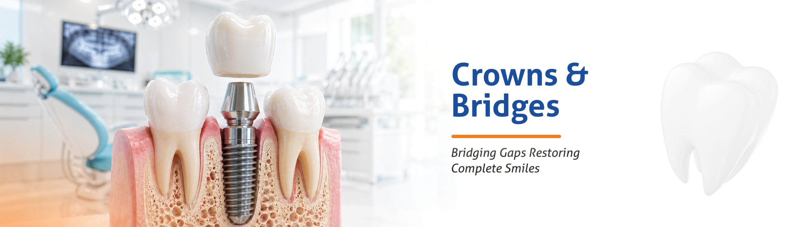 Crowns Bridges