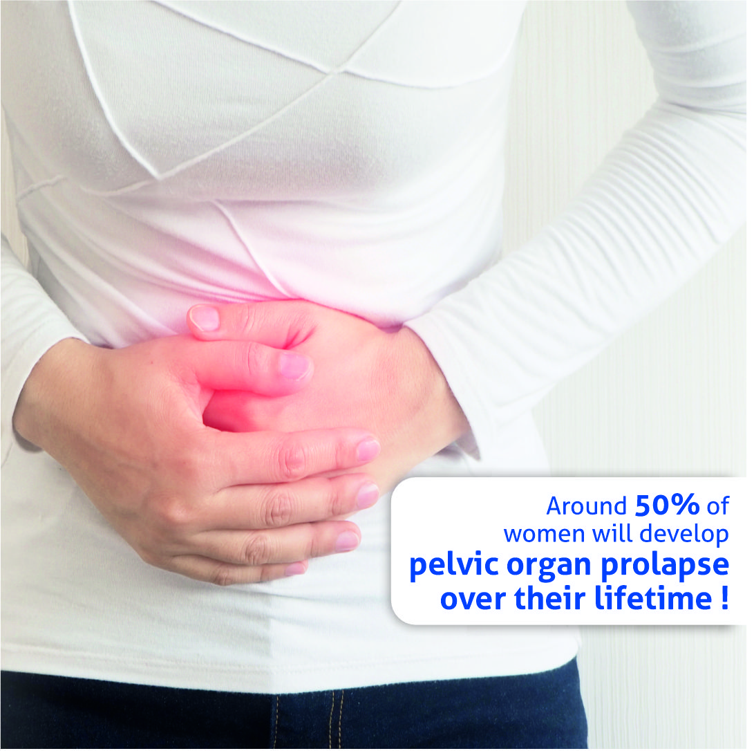 Around 50% of Women Will Develop Pelvic Organ Prolapse Over Their Lifetime