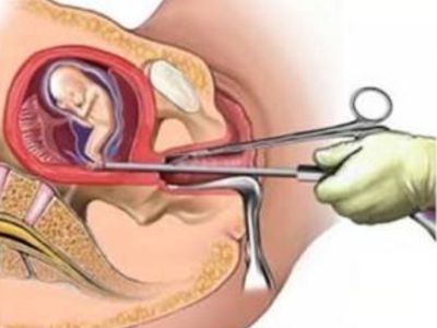 Oral Medical Termination Of Pregnancy