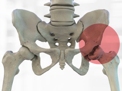 Promotional Arthroplasty Right Hip Health Check-UP Package