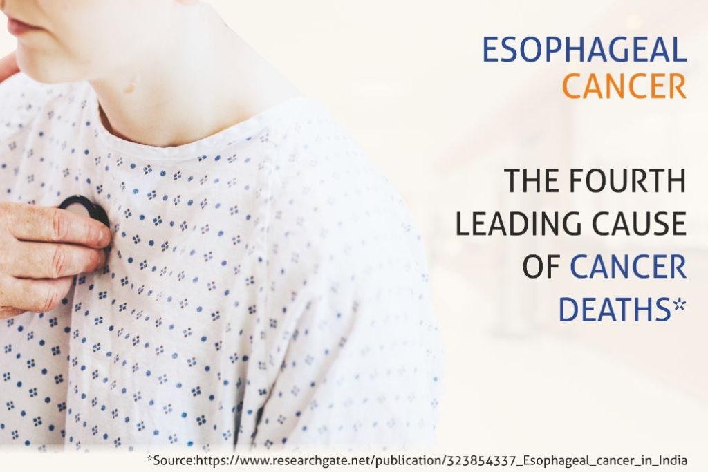 Esophageal Cancer: The Fourth Leading Cause of Cancer Deaths