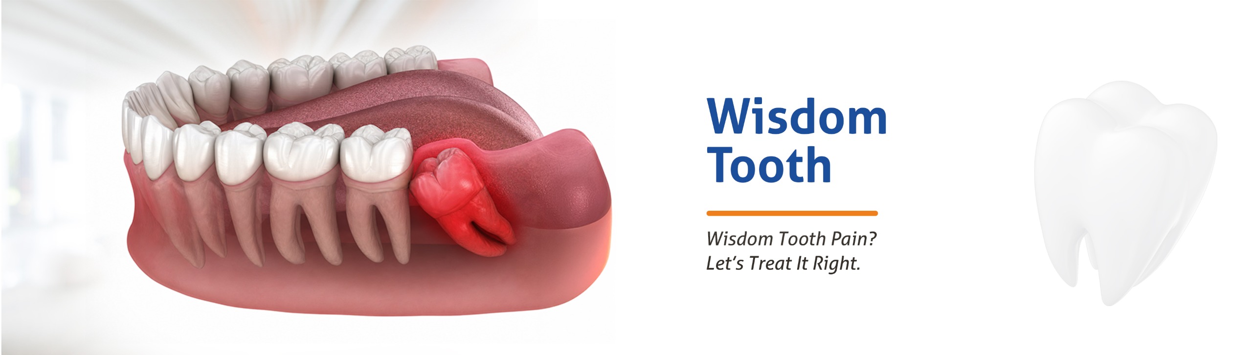 Wisdom Tooth removal - Shalby Dental clinic